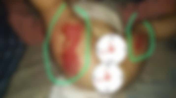Desarrollo Humano intervino ante la viralización de la foto de un bebé quemado "sin atención médica"