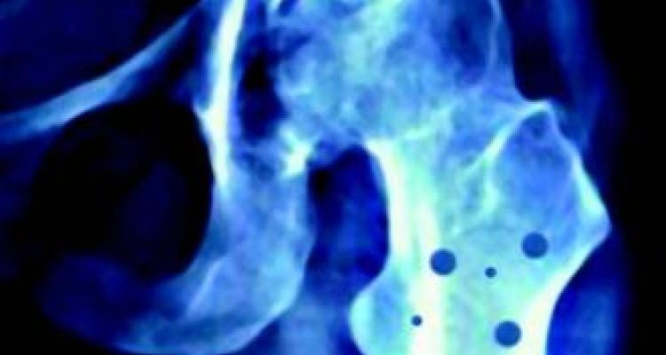 Contra la Osteoporosis