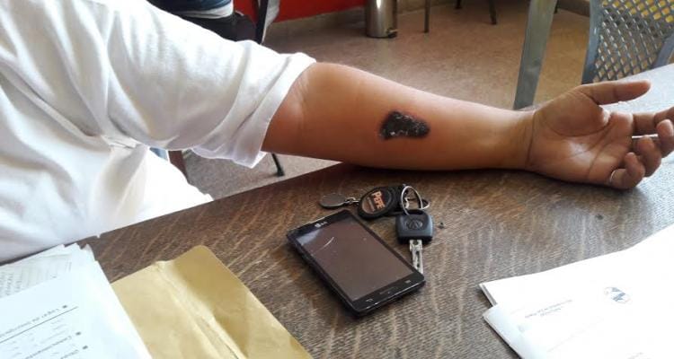 Se borró el tatuaje para que la admitan en la Policía Local