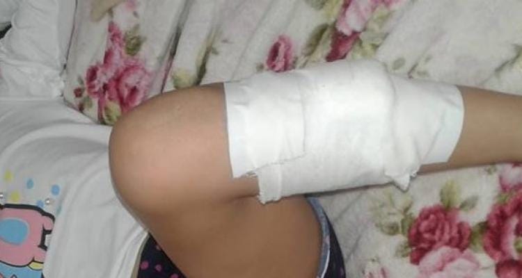 Perro callejero mordió a un niña de 6 años y tuvieron que suturarle la herida