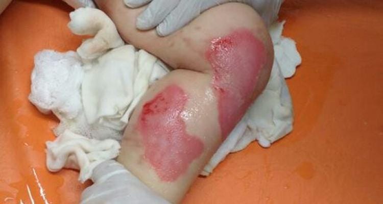 Se recupera niña que se quemó la piel en un jardín maternal