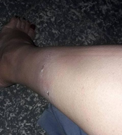 Una joven fue atacada y lesionada por perros callejeros: “Nadie se hace responsable”